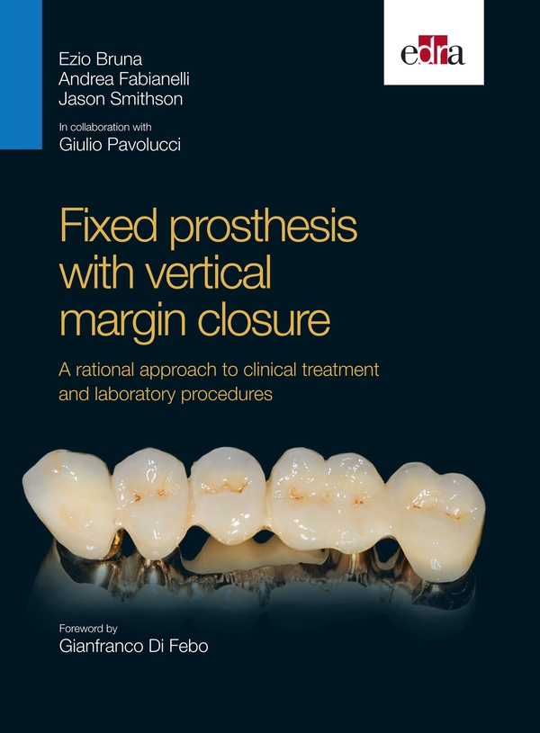 Fixed prosthesis with vertical margin closure - Librerie.coop Fixed prosthesis with vertical margin closure - Librerie.coop