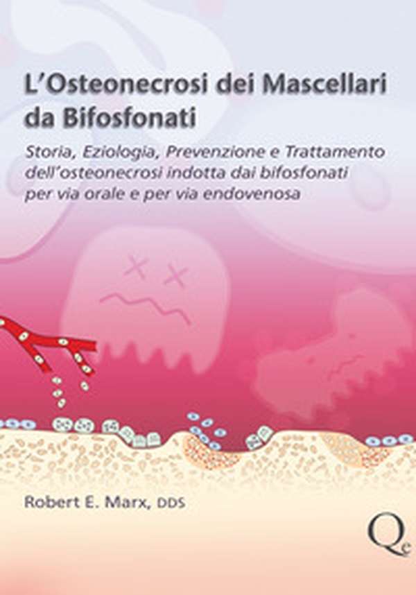 L'osteonecrosi dei mascellari da bifosfonati - Librerie.coop L'osteonecrosi dei mascellari da bifosfonati - Librerie.coop
