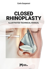 Closed rhinoplasty. Illustrated technical manual - Librerie.coop