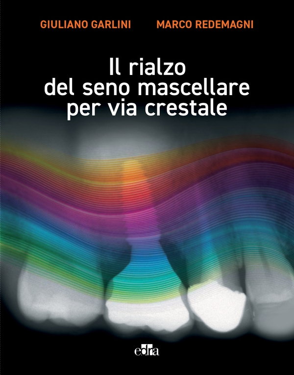 Il rialzo del seno mascellare per via crestale - Librerie.coop Il rialzo del seno mascellare per via crestale - Librerie.coop