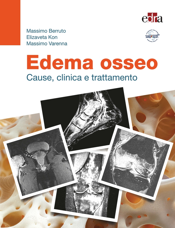 Edema osseo - Librerie.coop Edema osseo - Librerie.coop