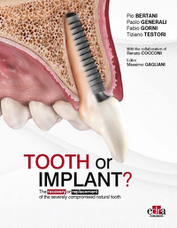 Tooth or Implant? The recovery or replacement of the severely compormised natural tooth - Librerie.coop