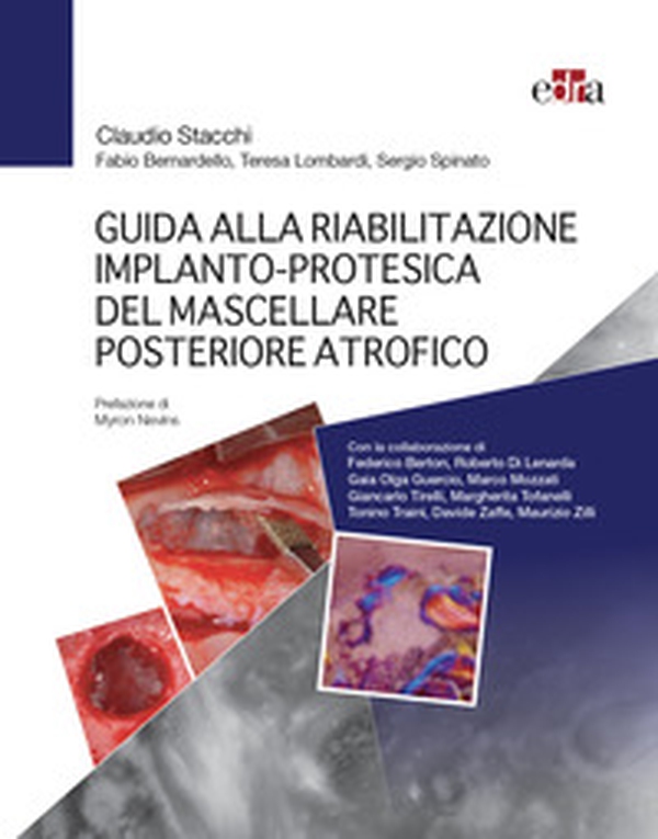 Guida alla riabilitazione implantoprotesica del mascellare posteriore atrofico - Librerie.coop Guida alla riabilitazione implantoprotesica del mascellare posteriore atrofico - Librerie.coop