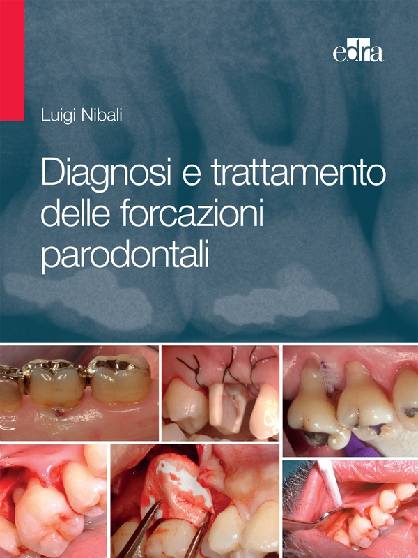 Diagnosi e trattamento delle forcazioni parodontali - Librerie.coop Diagnosi e trattamento delle forcazioni parodontali - Librerie.coop