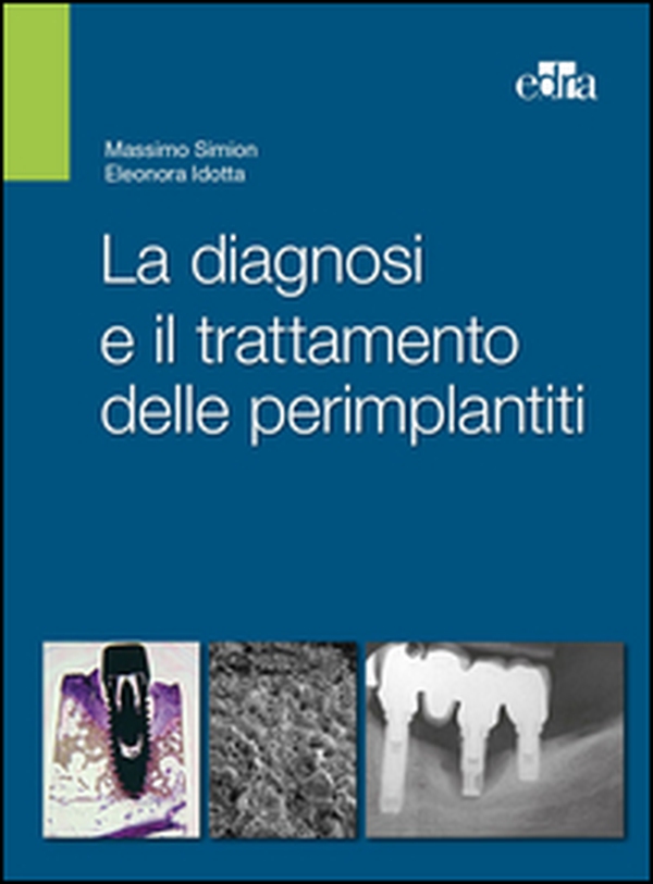 La diagnosi e il trattamento delle perimplantiti - Librerie.coop La diagnosi e il trattamento delle perimplantiti - Librerie.coop