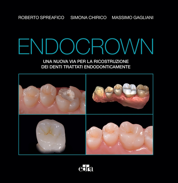 Endocrown - Librerie.coop Endocrown - Librerie.coop