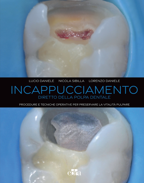 Incappucciamento diretto della polpa dentale - Librerie.coop Incappucciamento diretto della polpa dentale - Librerie.coop