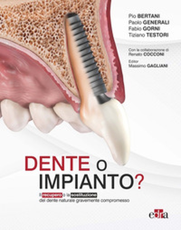 Dente o impianto? Il recupero o la sostituzione del dente naturale gravemente compromesso - Librerie.coop Dente o impianto? Il recupero o la sostituzione del dente naturale gravemente compromesso - Librerie.coop