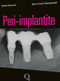 Peri-implantite - Librerie.coop