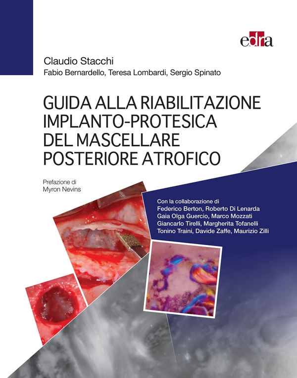 Guida alla riabilitazione implantoprotesica del mascellare posteriore atrofico - Librerie.coop Guida alla riabilitazione implantoprotesica del mascellare posteriore atrofico - Librerie.coop
