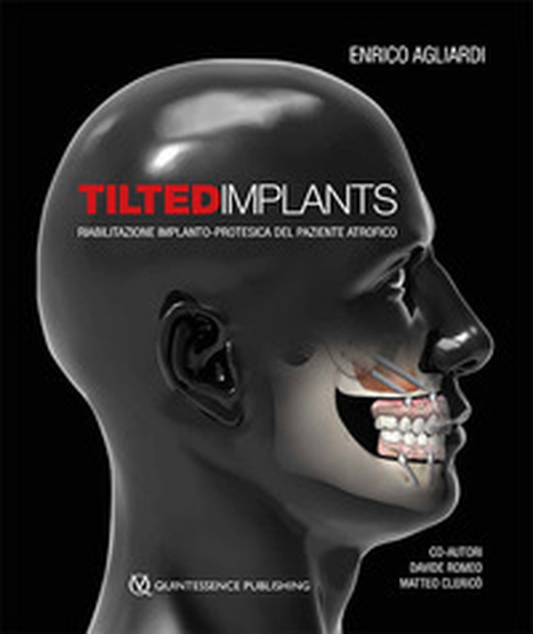 Tilted implants. Riabilitazione implanto-protesica del paziente atrofico - Librerie.coop Tilted implants. Riabilitazione implanto-protesica del paziente atrofico - Librerie.coop