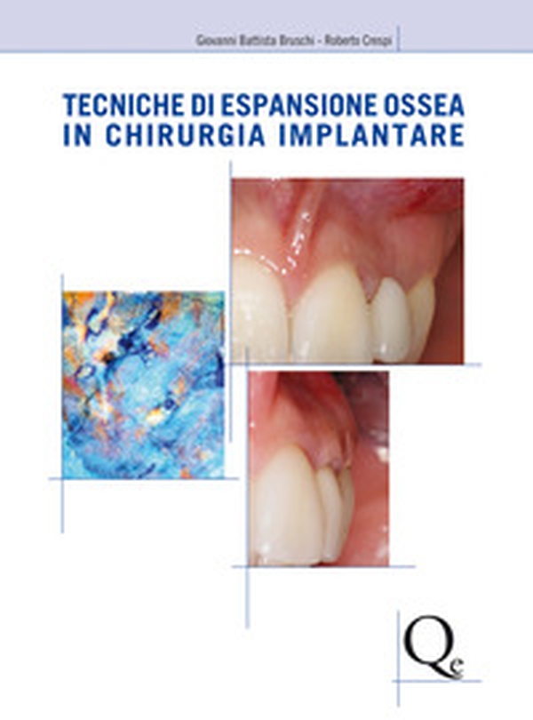 Tecniche di espansione ossea in chirurgia implantare - Librerie.coop Tecniche di espansione ossea in chirurgia implantare - Librerie.coop