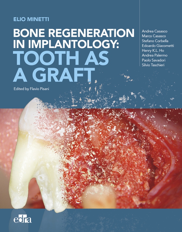 Bone regeneration in implantology: tooth as a graft - Librerie.coop Bone regeneration in implantology: tooth as a graft - Librerie.coop