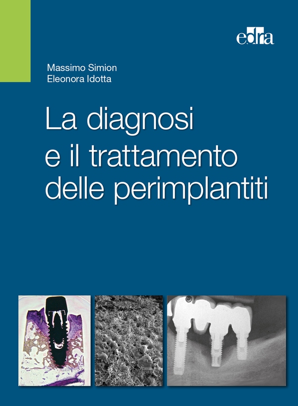 La diagnosi e il trattamento delle perimplantiti - Librerie.coop La diagnosi e il trattamento delle perimplantiti - Librerie.coop