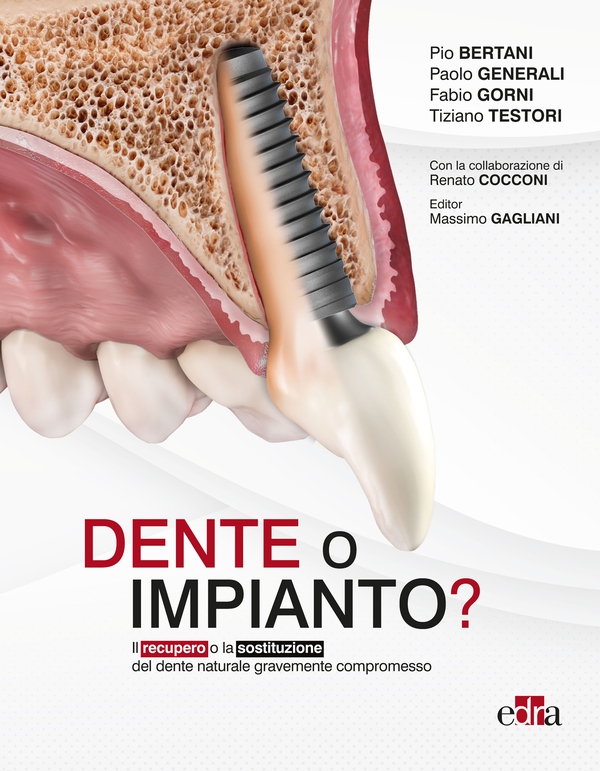 Dente o impianto? - Librerie.coop Dente o impianto? - Librerie.coop