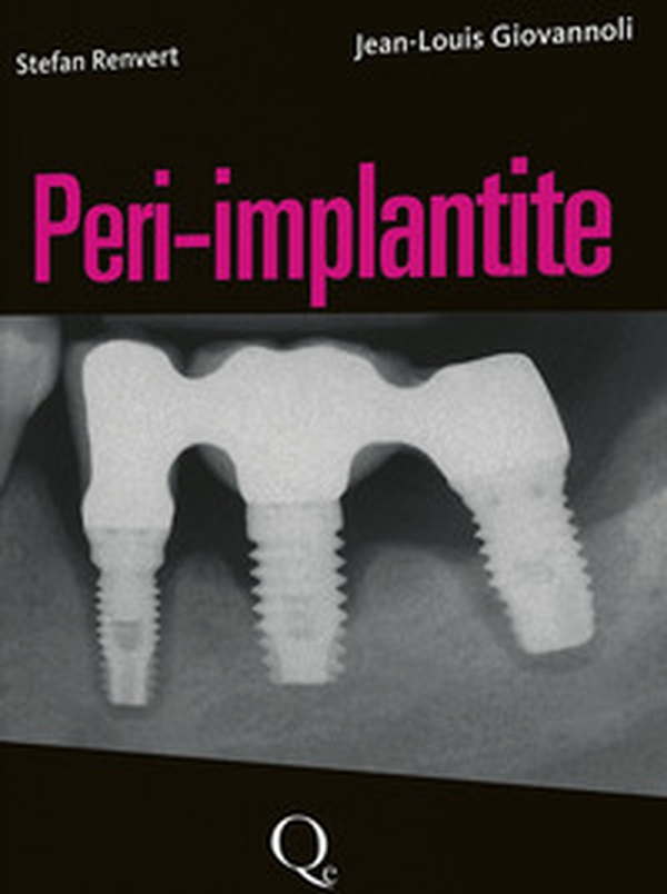 Peri-implantite - Librerie.coop Peri-implantite - Librerie.coop