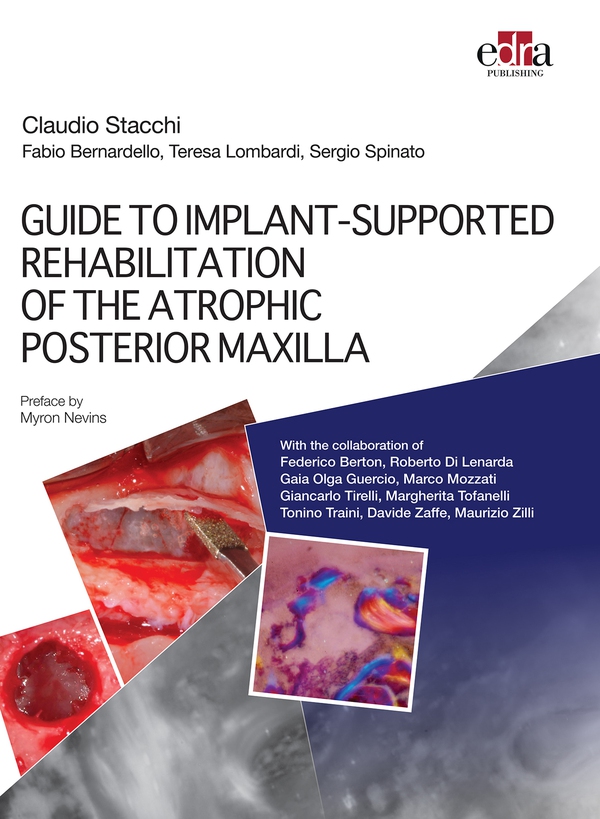 GUIDE TO IMPLANT-SUPPORTED REHABILITATION OF THE ATROPHIC POSTERIOR MAXILLA - Librerie.coop GUIDE TO IMPLANT-SUPPORTED REHABILITATION OF THE ATROPHIC POSTERIOR MAXILLA - Librerie.coop