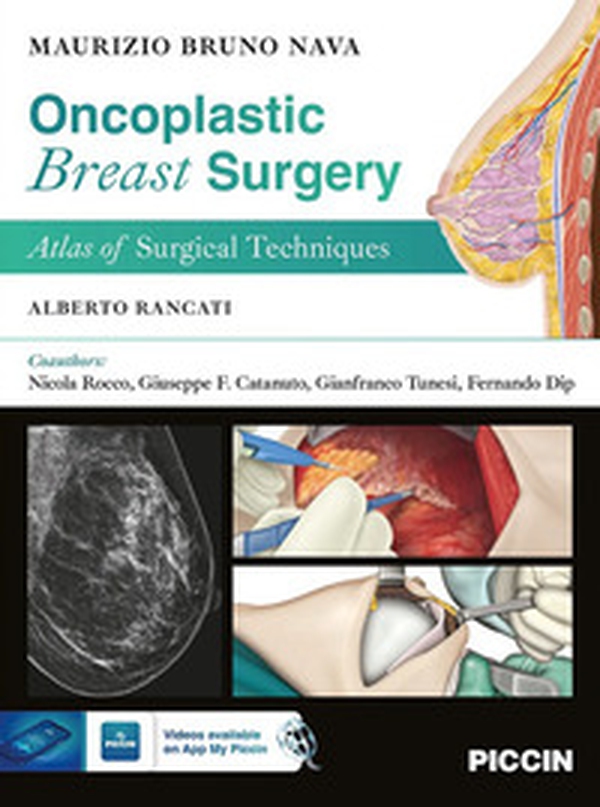 Oncoplastic breast surgery. Atlas of surgical techniques - Librerie.coop