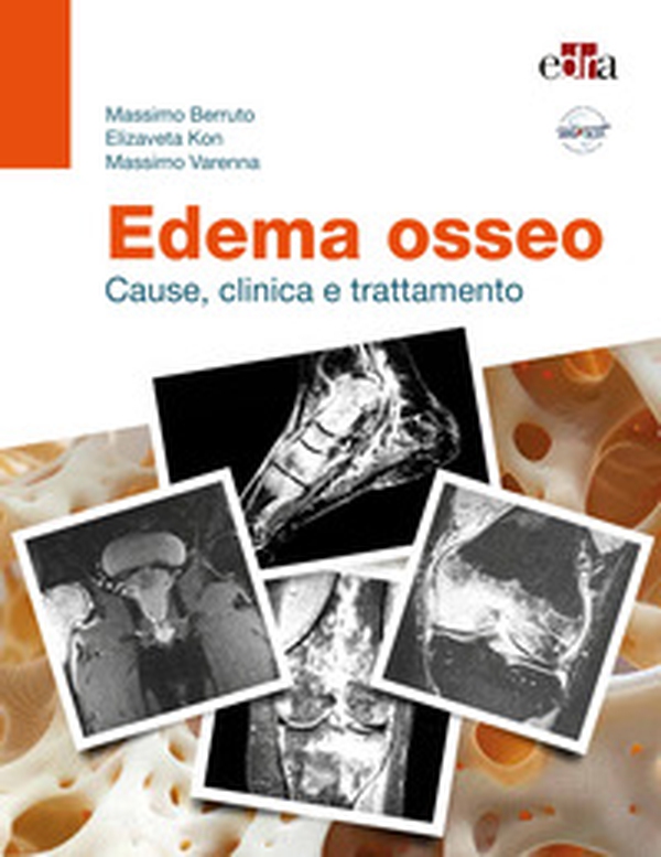 Edema osseo. Cause, clinica e trattamento - Librerie.coop